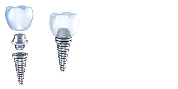 歯科インプラントの特徴